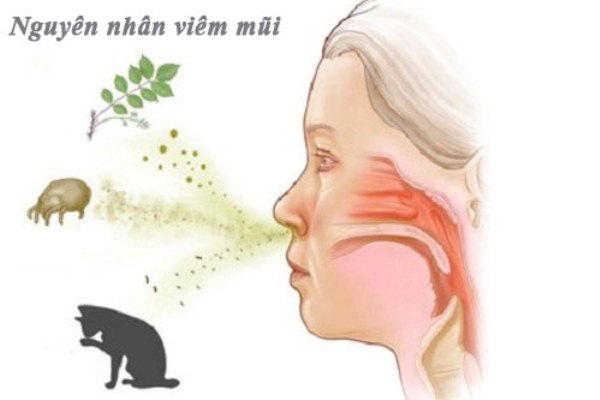 Nguyên nhân viêm mũi vân mạch