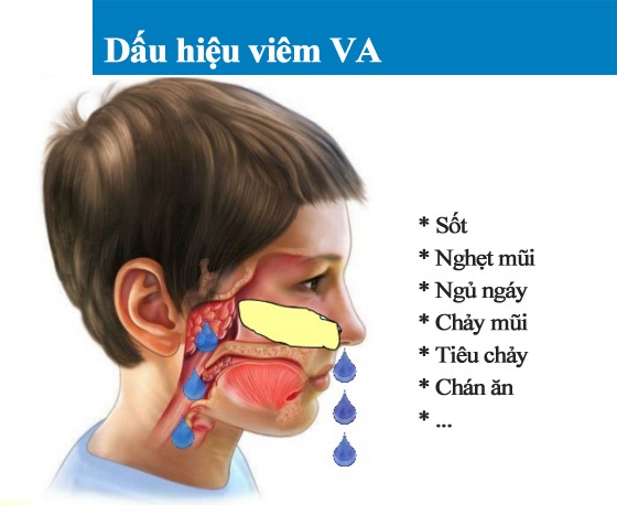 Viêm mũi VA ở trẻ
